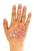 The facts about psoriasis